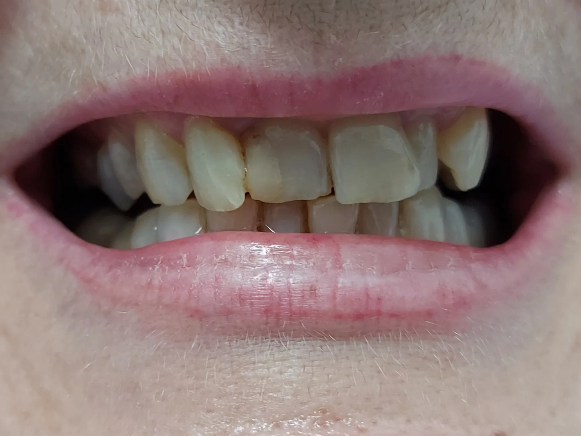 Antes - estética